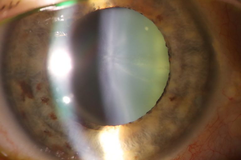 Cataracts And Intraocular Lenses Dr Tom Cunneen Eye Surgery Perth